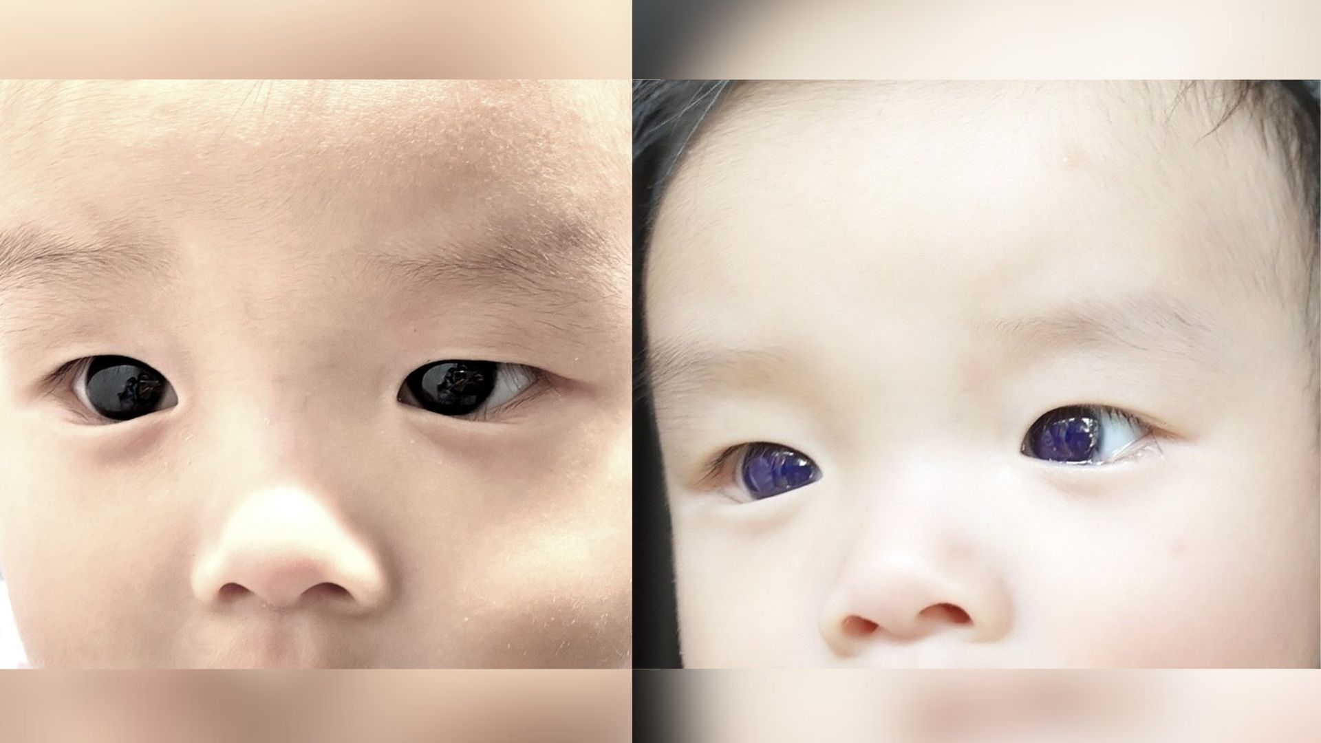 Mudanças de Cor nos Olhos de um Bebê Após Tratamento com Antiviral para COVID-19