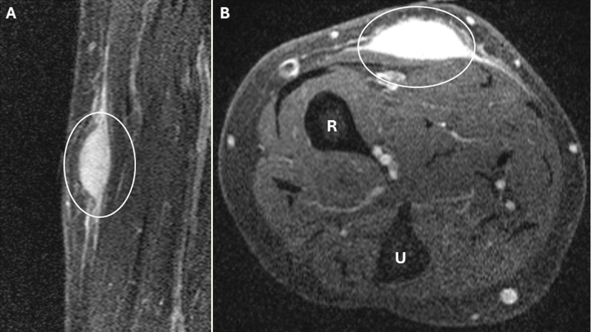 Regressão Espontânea: O Mistério da Tumor que Desapareceu Após uma Biópsia
