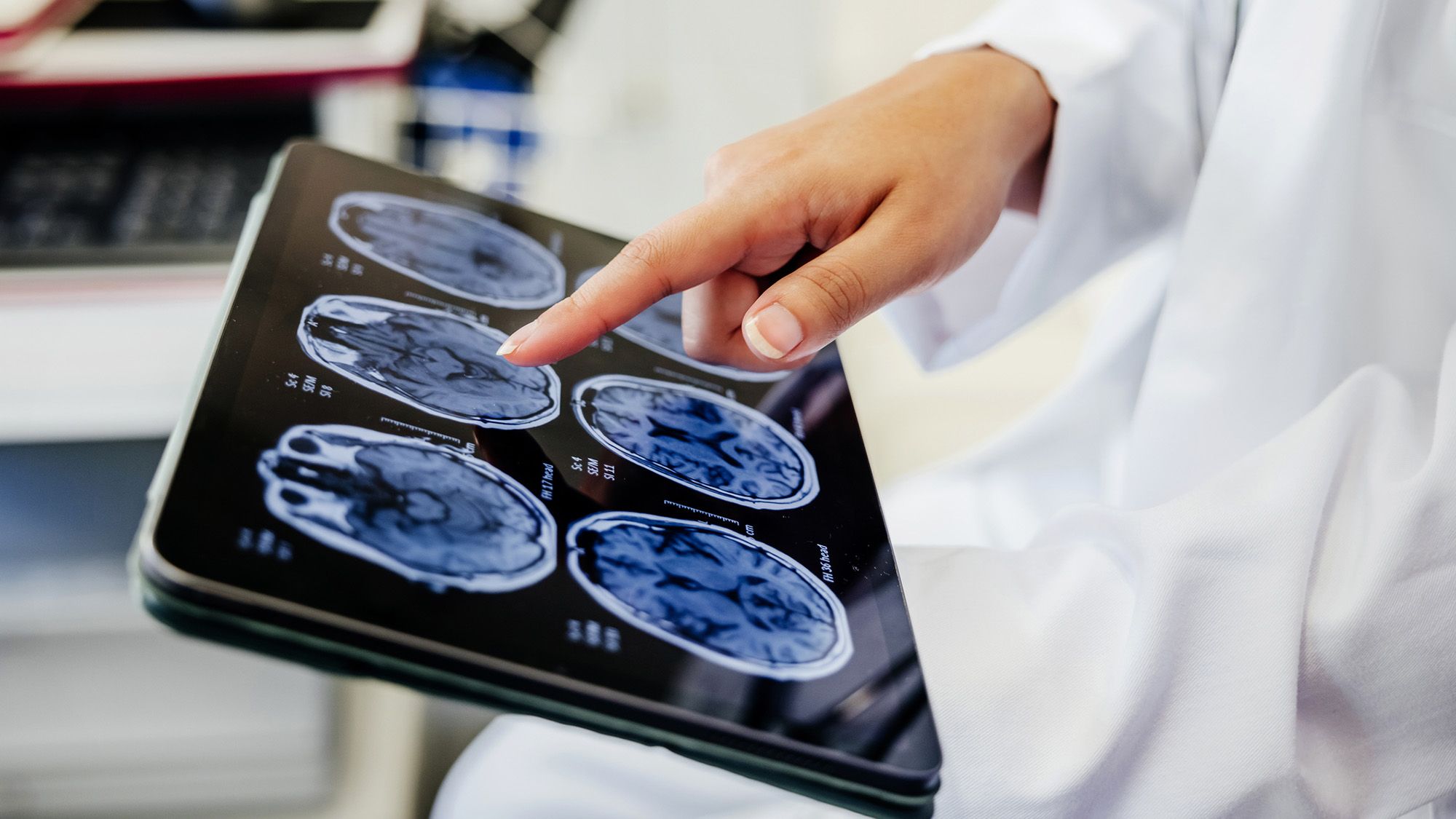Nova Esperança: Tratamento Experimental Induzindo Hipotermia Pode Proteger o Cérebro Após Acidente Vascular Cerebral