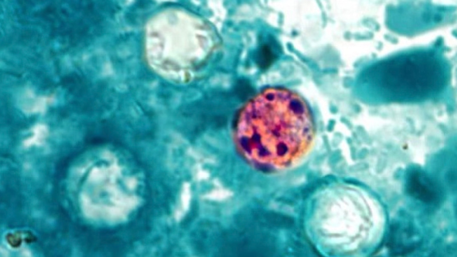 Surto de Ciclospora se Expande nos EUA: CDC Aponta Alface Americana como Fonte